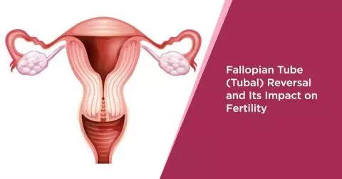 Fallopian Tube Tubal Reversal and Its Impact on Fertility NOVA IVF